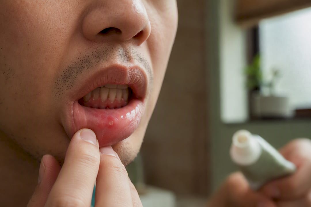 Close-up of mouth ulcer and toothpaste tube