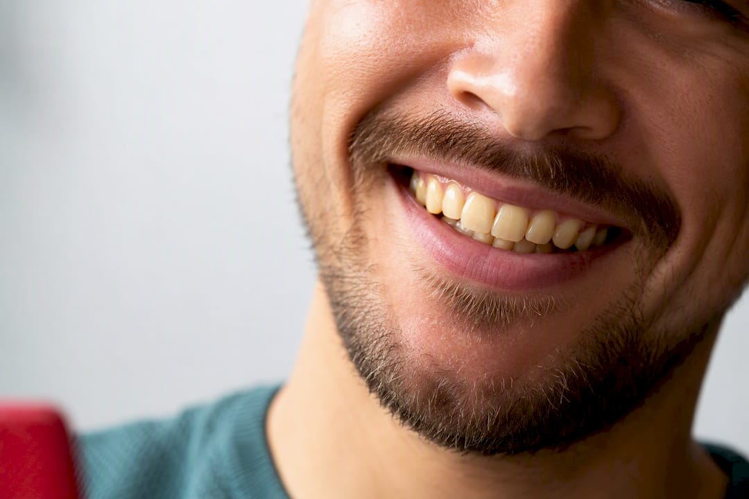 Natural smile showing mild yellow surface staining