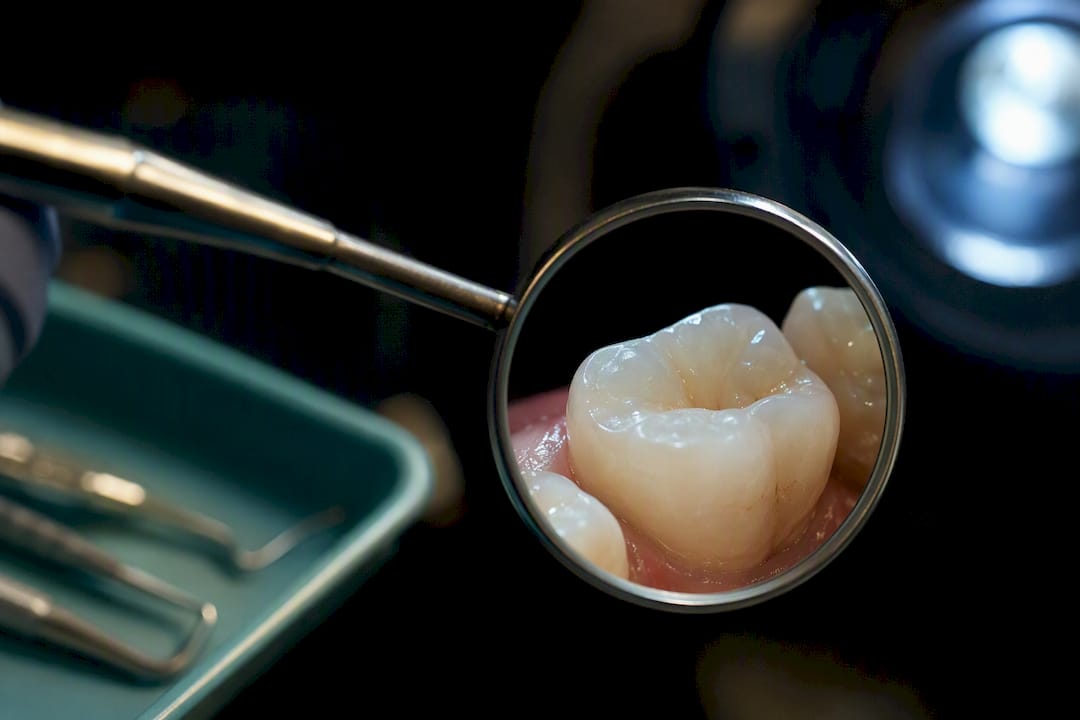 Macro view of enamel under dental examination